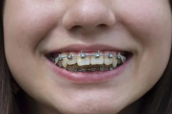 How Dental Alignment Boosts Confidence and Health